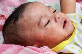Newborns Were Exposed to Measles